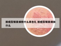 脓疱型银屑病擦什么再包扎 脓疱型银屑病抹什么