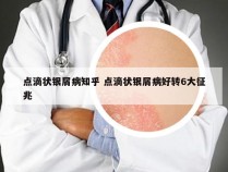 点滴状银屑病知乎 点滴状银屑病好转6大征兆