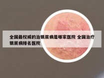 全国最权威的治银屑病是哪家医院 全国治疗银屑病排名医院
