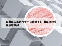在太原人民医院看牛皮癣好不好 太原医院看皮肤哪家好
