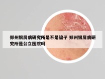 郑州银屑病研究所是不是骗子 郑州银屑病研究所是公立医院吗