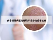南宁银屑病医院哪较好 南宁治疗牛皮癣