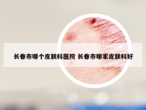 长春市哪个皮肤科医院 长春市哪家皮肤科好