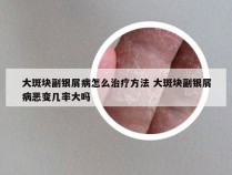 大斑块副银屑病怎么治疗方法 大斑块副银屑病恶变几率大吗