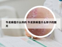 牛皮癣是什么样的 牛皮肤癣是什么样子的图片