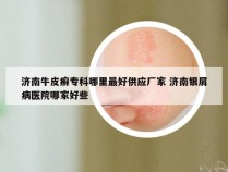 济南牛皮癣专科哪里最好供应厂家 济南银屑病医院哪家好些