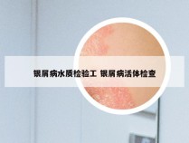 银屑病水质检验工 银屑病活体检查