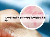 艾叶对牛皮癣有治疗作用吗 艾草能治牛皮癣吗?