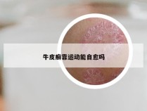 牛皮癣靠运动能自愈吗