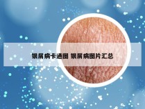 银屑病卡通图 银屑病图片汇总