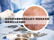 神经性皮炎跟银屑病怎么区分 神经性皮炎跟银屑病怎么区分图片