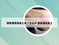 银屑病发现身上有了怎么办 银屑病长身上