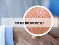 牛皮癣患者吃阿胶会严重么