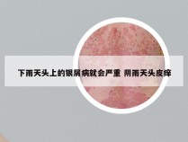 下雨天头上的银屑病就会严重 阴雨天头皮痒