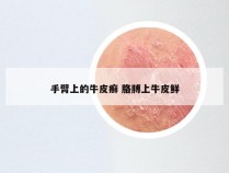 手臂上的牛皮癣 胳膊上牛皮鲜