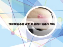 银屑病能不能染发 银屑病不能染头发吗