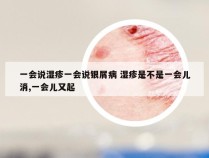 一会说湿疹一会说银屑病 湿疹是不是一会儿消,一会儿又起