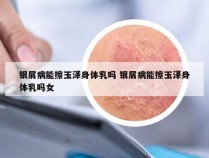 银屑病能擦玉泽身体乳吗 银屑病能擦玉泽身体乳吗女