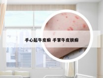 手心起牛皮癣 手掌牛皮肤癣