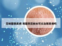 花椒醋银屑病 用醋熬花椒水可以治银屑病吗