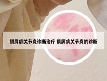 银屑病关节炎诊断治疗 银屑病关节炎的诊断