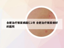 合肥治疗银屑病国仁2寻 合肥治疗银屑病好的医院
