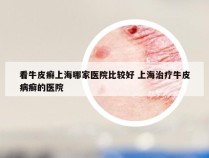 看牛皮癣上海哪家医院比较好 上海治疗牛皮病癣的医院