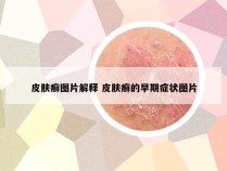 皮肤癣图片解释 皮肤癣的早期症状图片