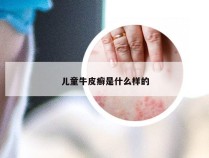 儿童牛皮癣是什么样的