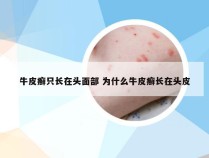 牛皮癣只长在头面部 为什么牛皮癣长在头皮