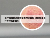 治疗银屑病洛阳哪家医院比较好 洛阳哪里治疗牛皮癣比较好