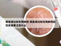 银屑病注射生物制剂 银屑病注射生物制剂后饮食需要注意什么