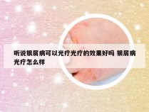 听说银屑病可以光疗光疗的效果好吗 银屑病光疗怎么样