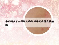 牛奶喝多了会得牛皮癣吗 喝牛奶会得皮肤病吗