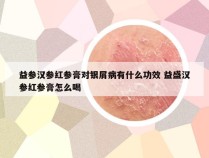益参汉参红参膏对银屑病有什么功效 益盛汉参红参膏怎么喝