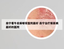 南宁看牛皮癣哪家医院最好 南宁治疗银屑病最好的医院