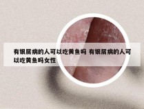 有银屑病的人可以吃黄鱼吗 有银屑病的人可以吃黄鱼吗女性