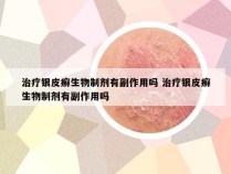 治疗银皮癣生物制剂有副作用吗 治疗银皮癣生物制剂有副作用吗