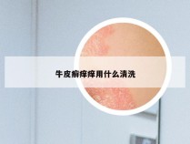 牛皮癣痒痒用什么清洗