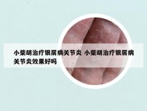 小柴胡治疗银屑病关节炎 小柴胡治疗银屑病关节炎效果好吗
