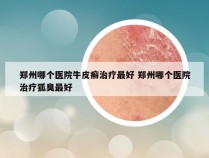 郑州哪个医院牛皮癣治疗最好 郑州哪个医院治疗狐臭最好