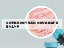 点滴型银屑病处于发展期 点滴型银屑病扩散是什么时期