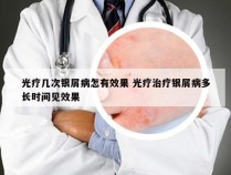 光疗几次银屑病怎有效果 光疗治疗银屑病多长时间见效果