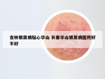 吉林银屑病贴心华山 长春华山银屑病医院好不好
