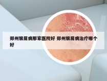 郑州银屑病那家医院好 郑州银屑病治疗哪个好