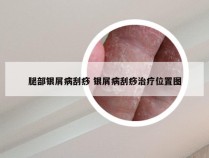 腿部银屑病刮痧 银屑病刮痧治疗位置图