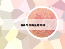 满身牛皮癣是啥原因