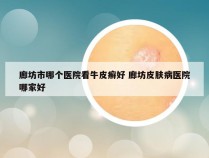 廊坊市哪个医院看牛皮癣好 廊坊皮肤病医院哪家好