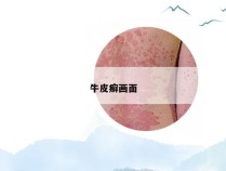 牛皮癣画面