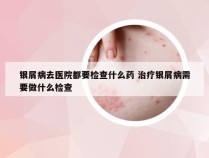 银屑病去医院都要检查什么药 治疗银屑病需要做什么检查